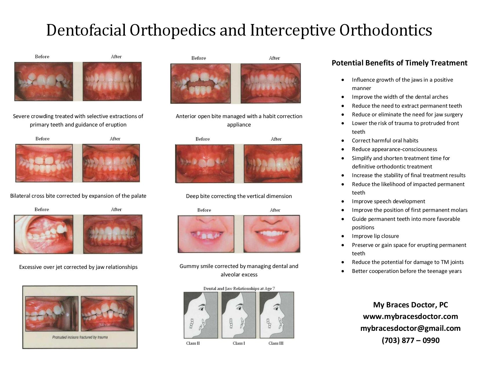 Interceptive orthodontics Fairfax, VA
